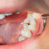 Tooth Caries Cavity