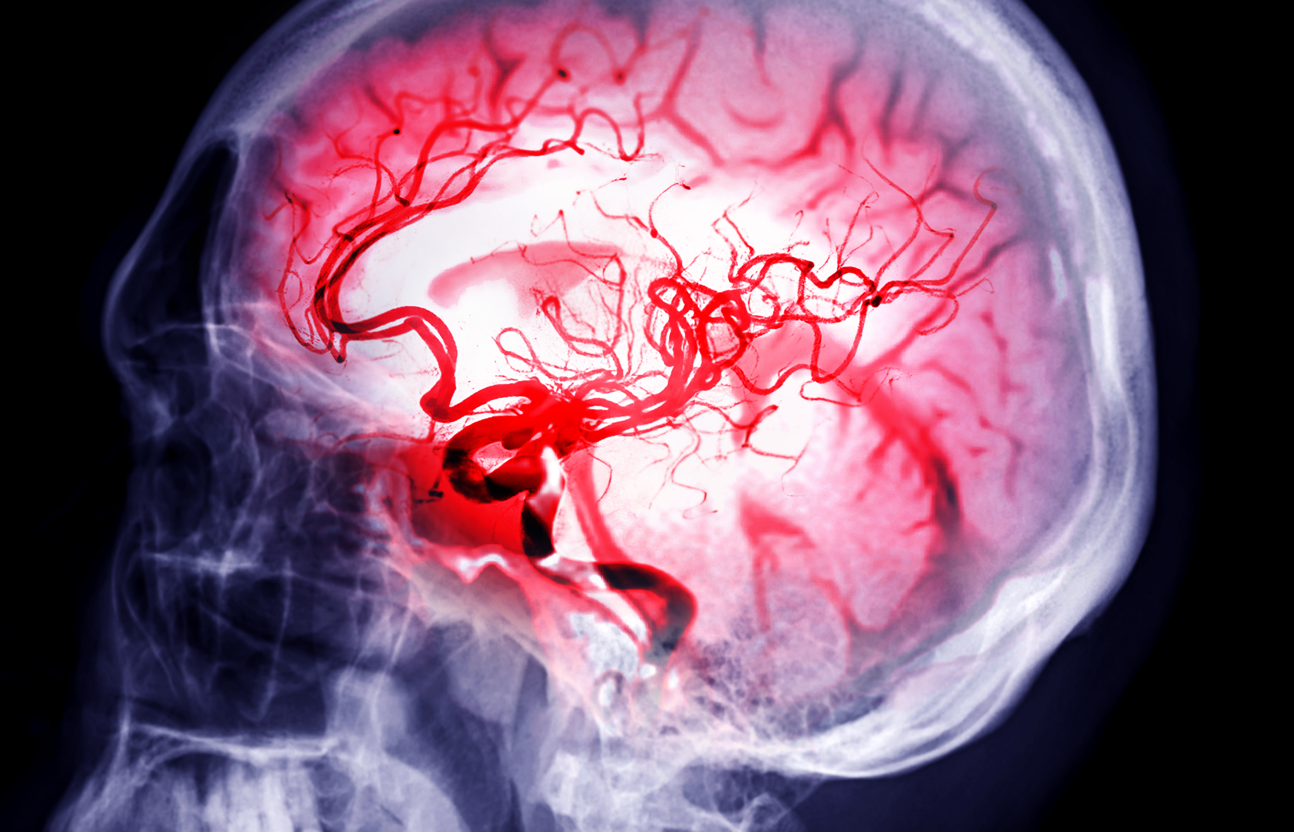 Brain Stroke Samunella