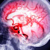 Brain Stroke Samunella