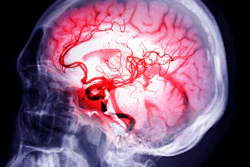 Brain Stroke Samunella