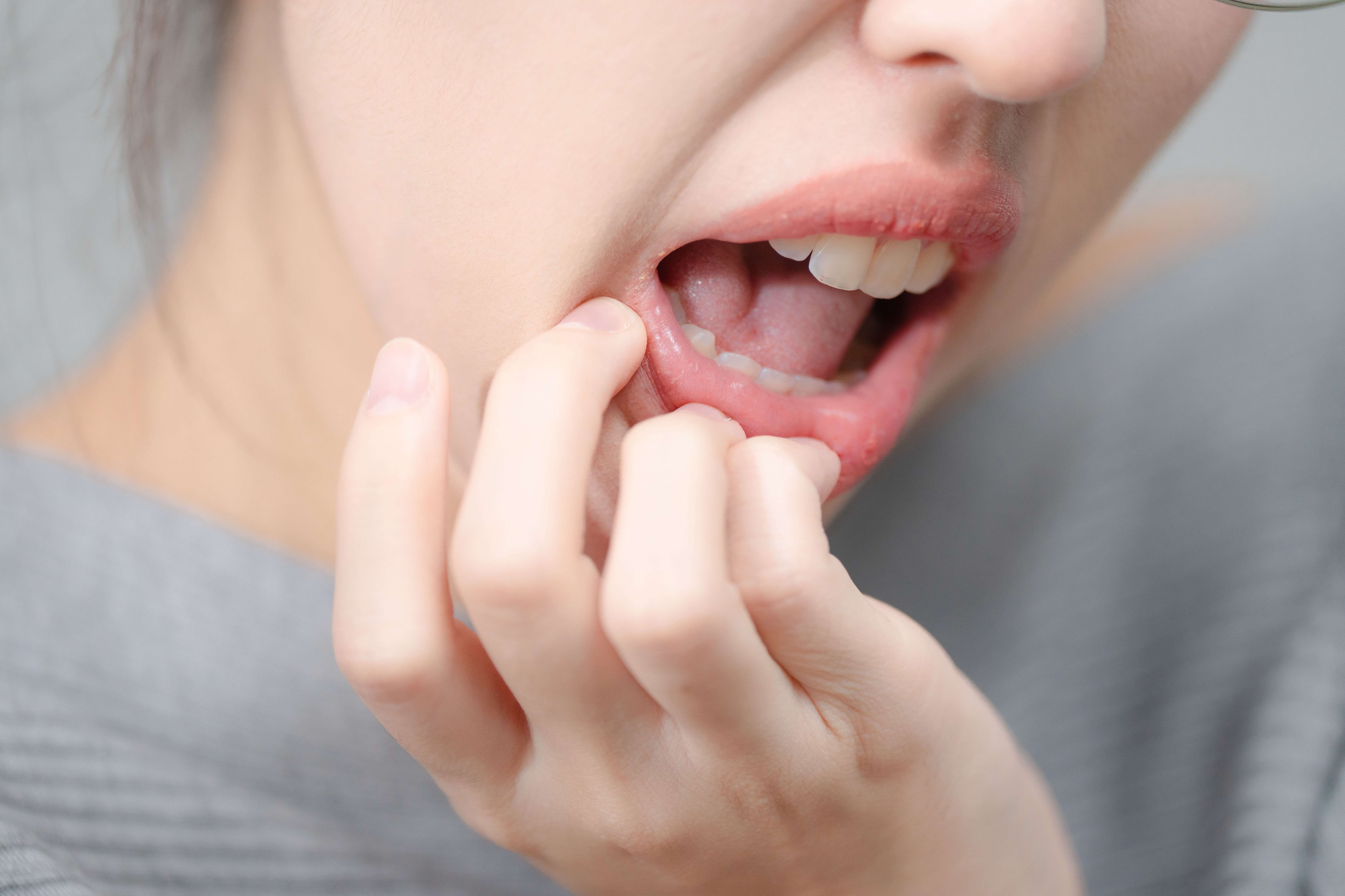 Mouth Ulcer Pain Thitiporn