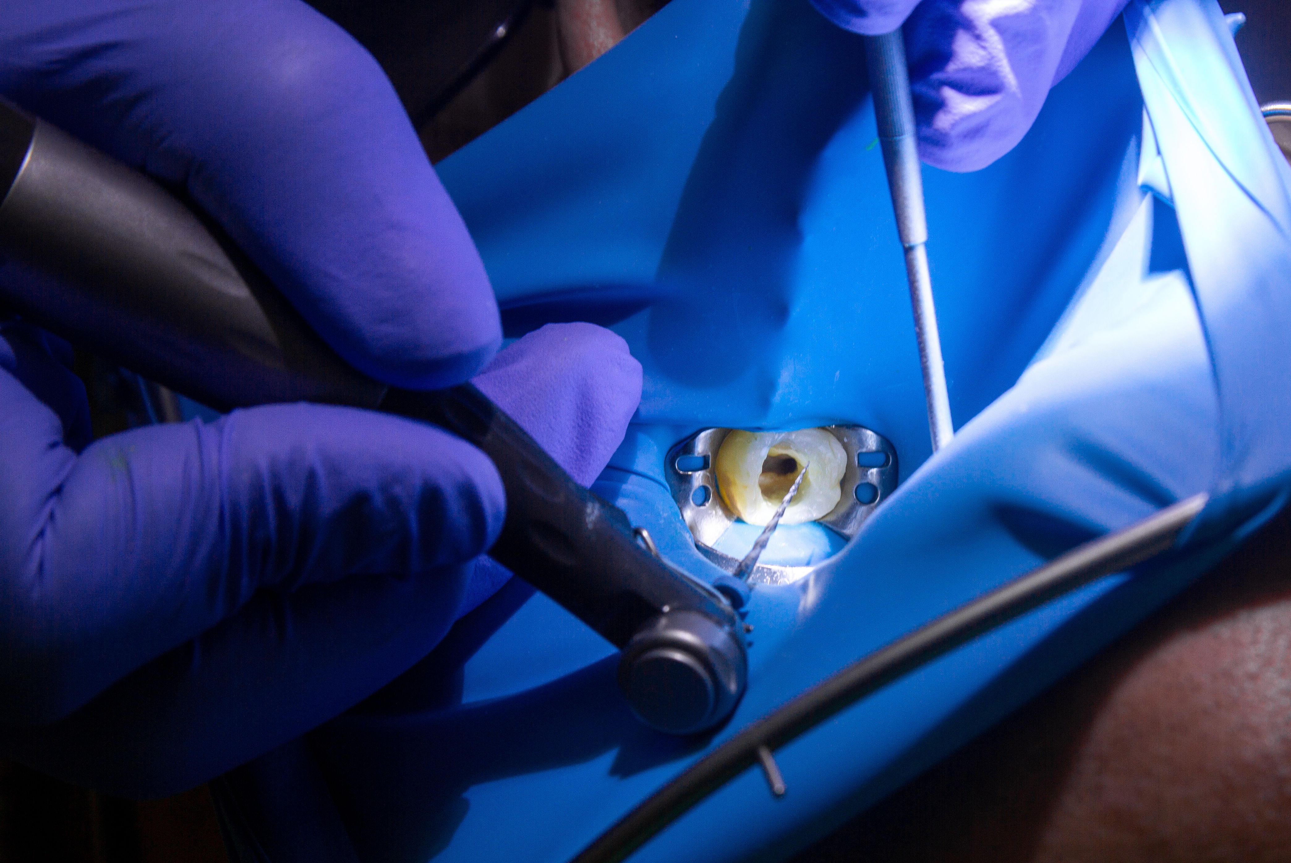 Root Canal Malyutinaanna