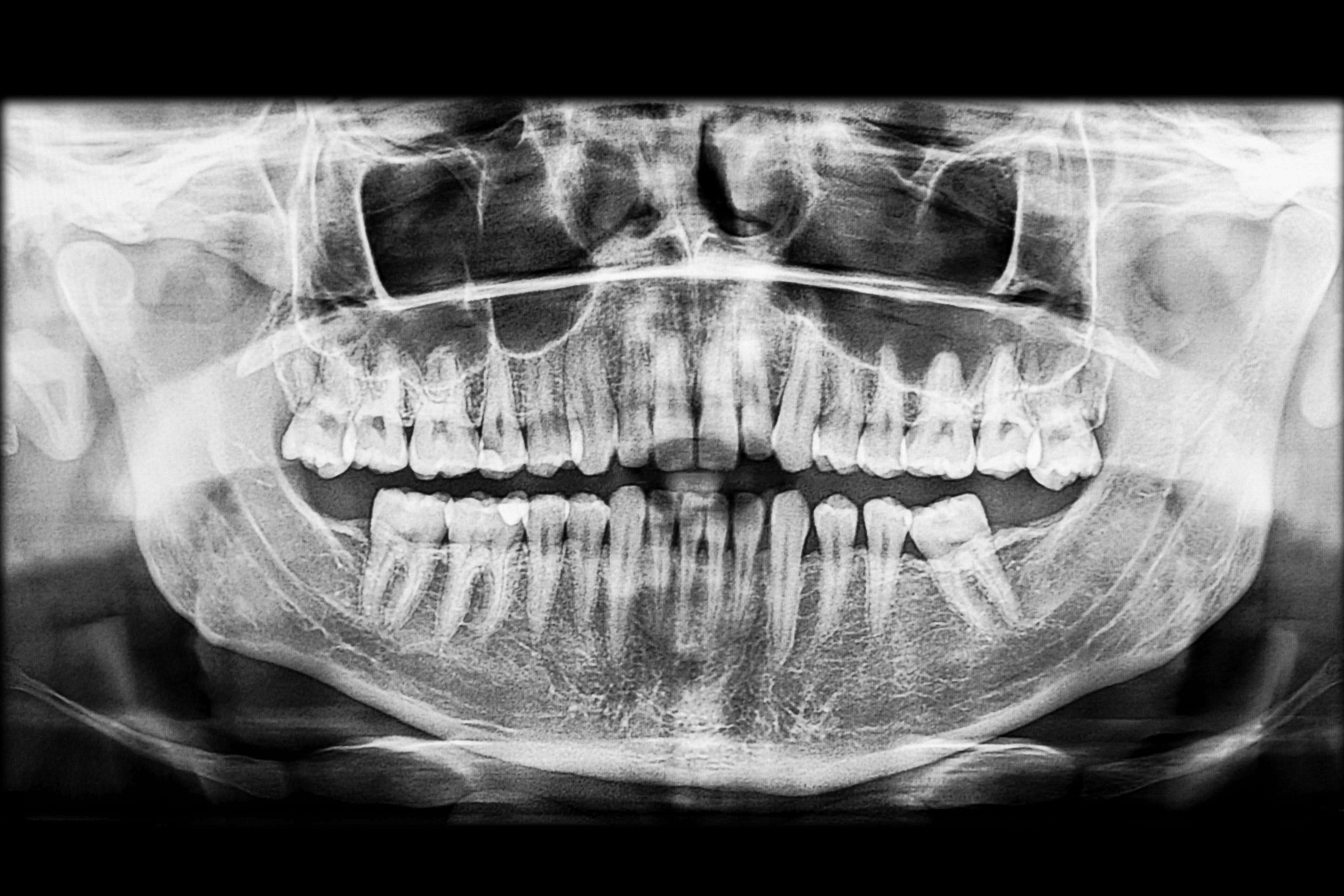 Xray Sinus Msc