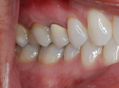 Figure 1: Tooth #3 previously had an existing full-coverage restoration with RCT.