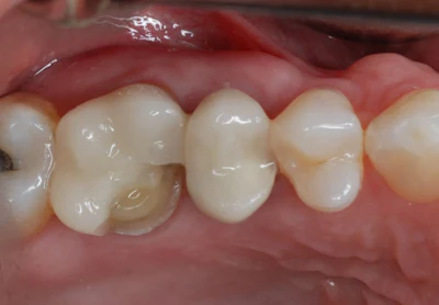 Figure 2: Fractured mesiolingual cusp on tooth #3.