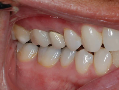 Figure 5: Post-op buccal view of Katana Zirconia One Speed restoration on tooth #3.