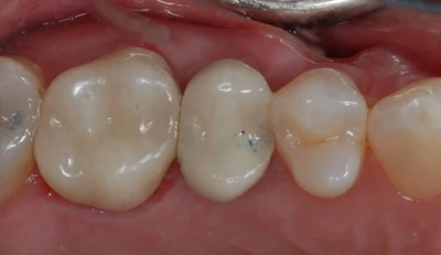 Figure 6: Post-op occlusal view of Katana Zirconia One Speed full-coverage crown on tooth #3.