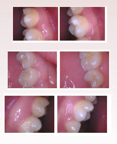 Figure 2: Post SRP with GBT, a laser, and StellaLife’s rinse and gel.