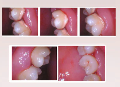 Figure 1: Before implementing SRP with guided biofilm therapy (GBT), a laser, and StellaLife’s rinse and gel.