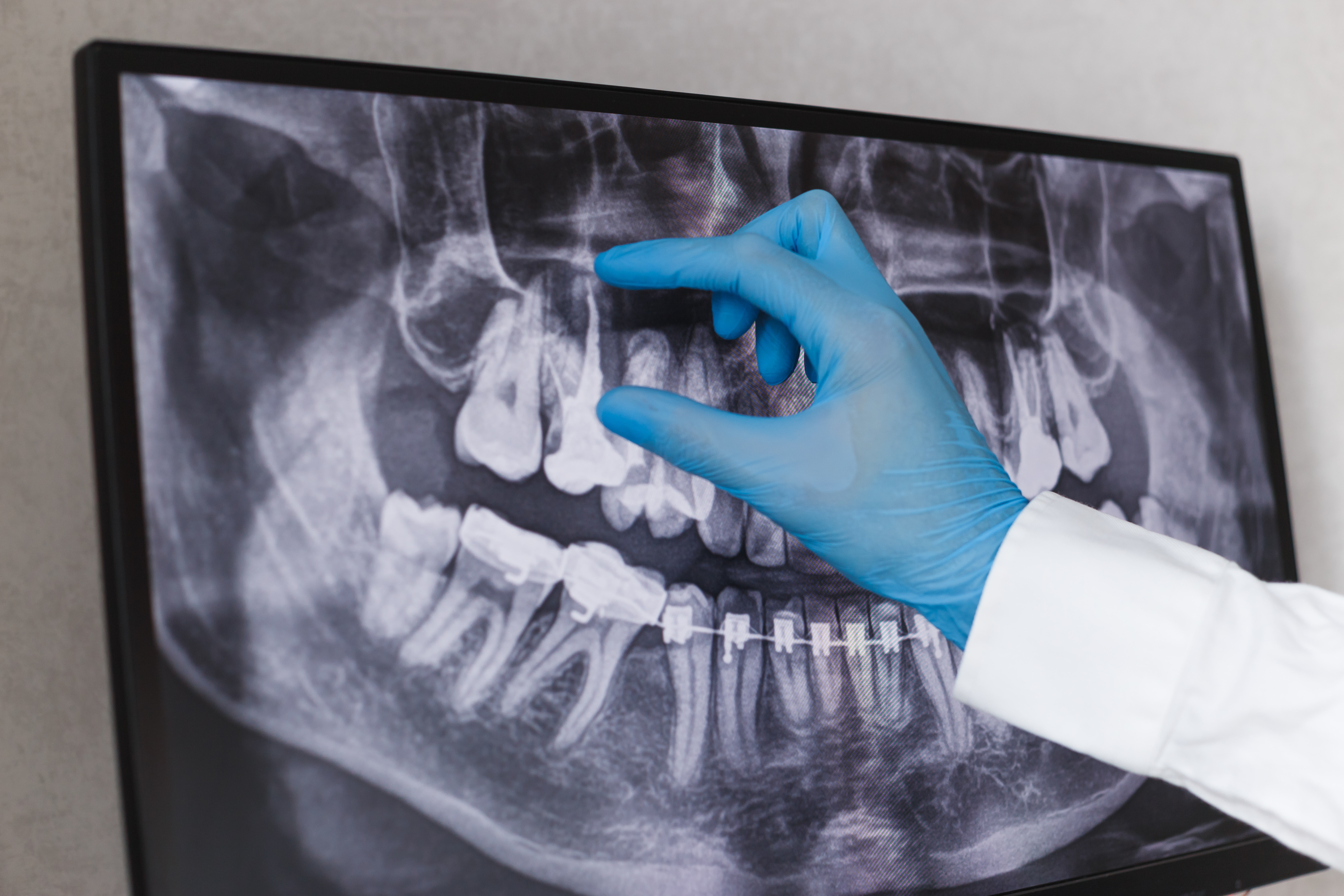 Dental X Ray