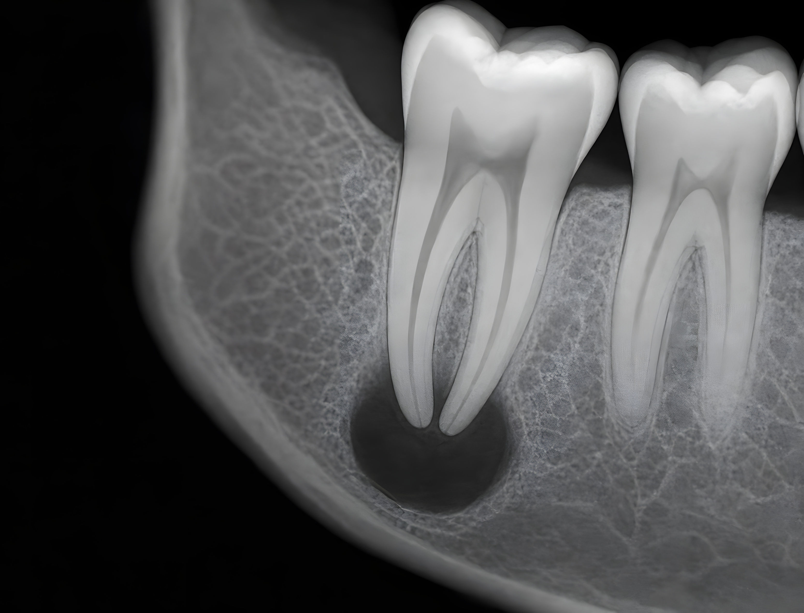 Periapical Lesion Radiograph Ultramcu