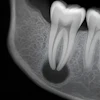 Periapical Lesion Radiograph Ultramcu
