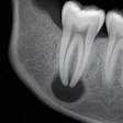 Periapical Lesion Radiograph Ultramcu