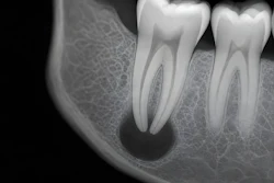 Periapical Lesion Radiograph Ultramcu