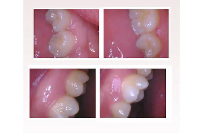 Four intraoral dental photographs showing tooth structures and gum tissue from different angles and positions.