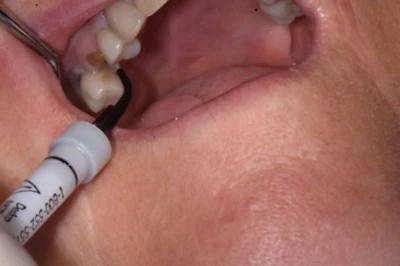 Figure 3: Treating the preparation with Consepsis (Ultradent).