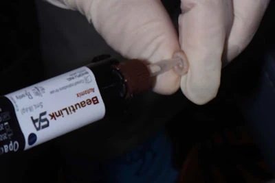 Figure 4: Placing BeautiLink SA automix into the zirconia crown.