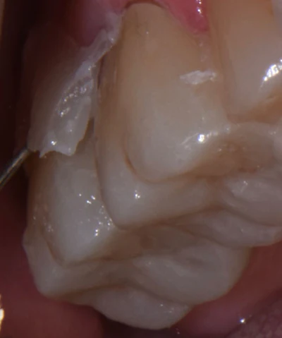 Figure 5: Simple removal of excess cement on the buccal surface of the restoration.
