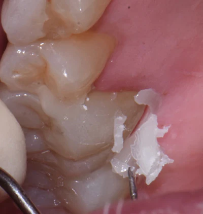 Figure 6: Simple removal of excess palatal cement. Using petroleum jelly is particularly valuable when removing cement from splinted crowns for teeth #2 and #3.