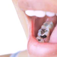 Amalgam Filling
