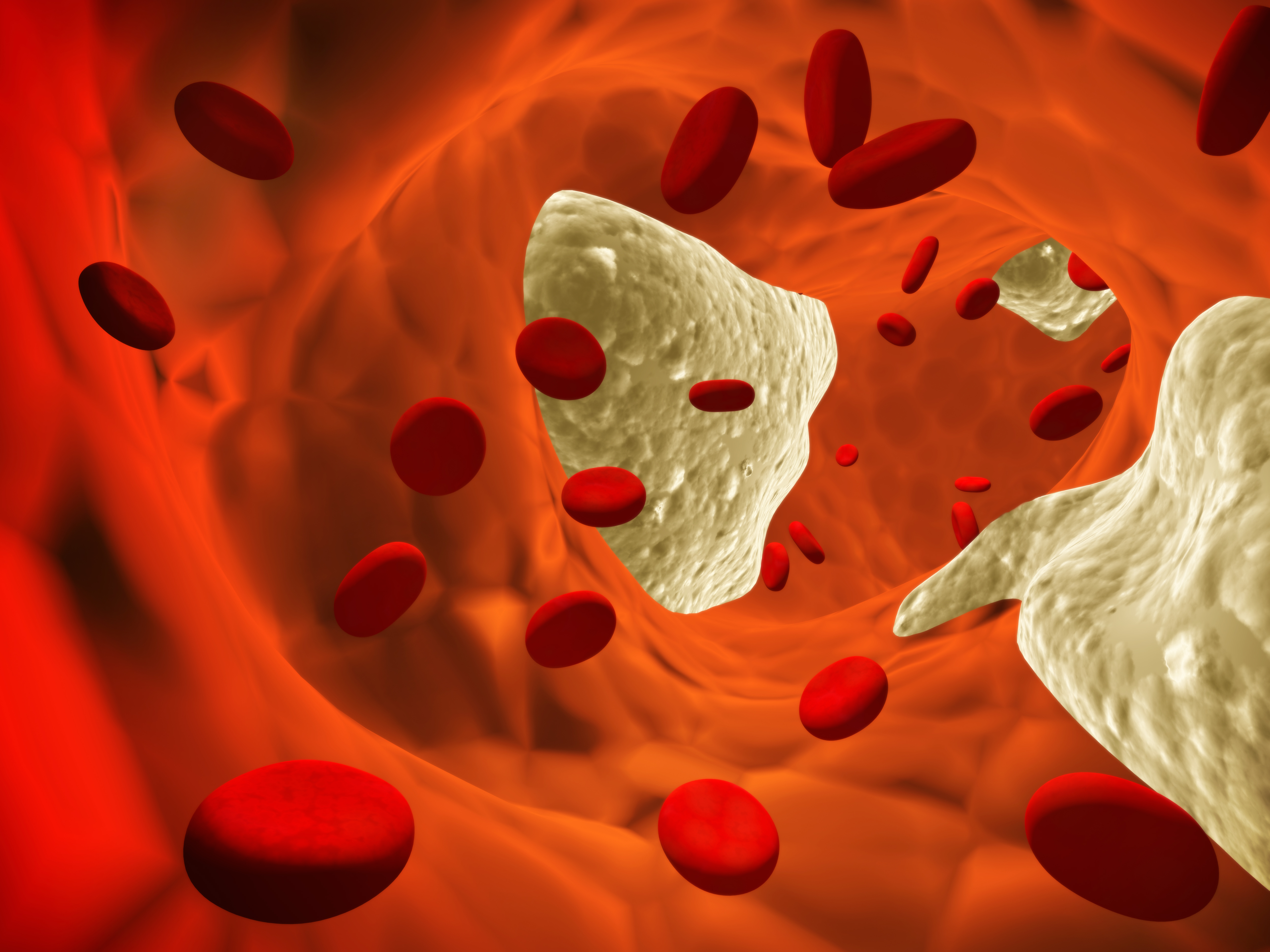 Atherosclerosis Clot