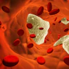 Atherosclerosis Clot
