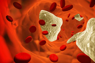 Atherosclerosis Clot