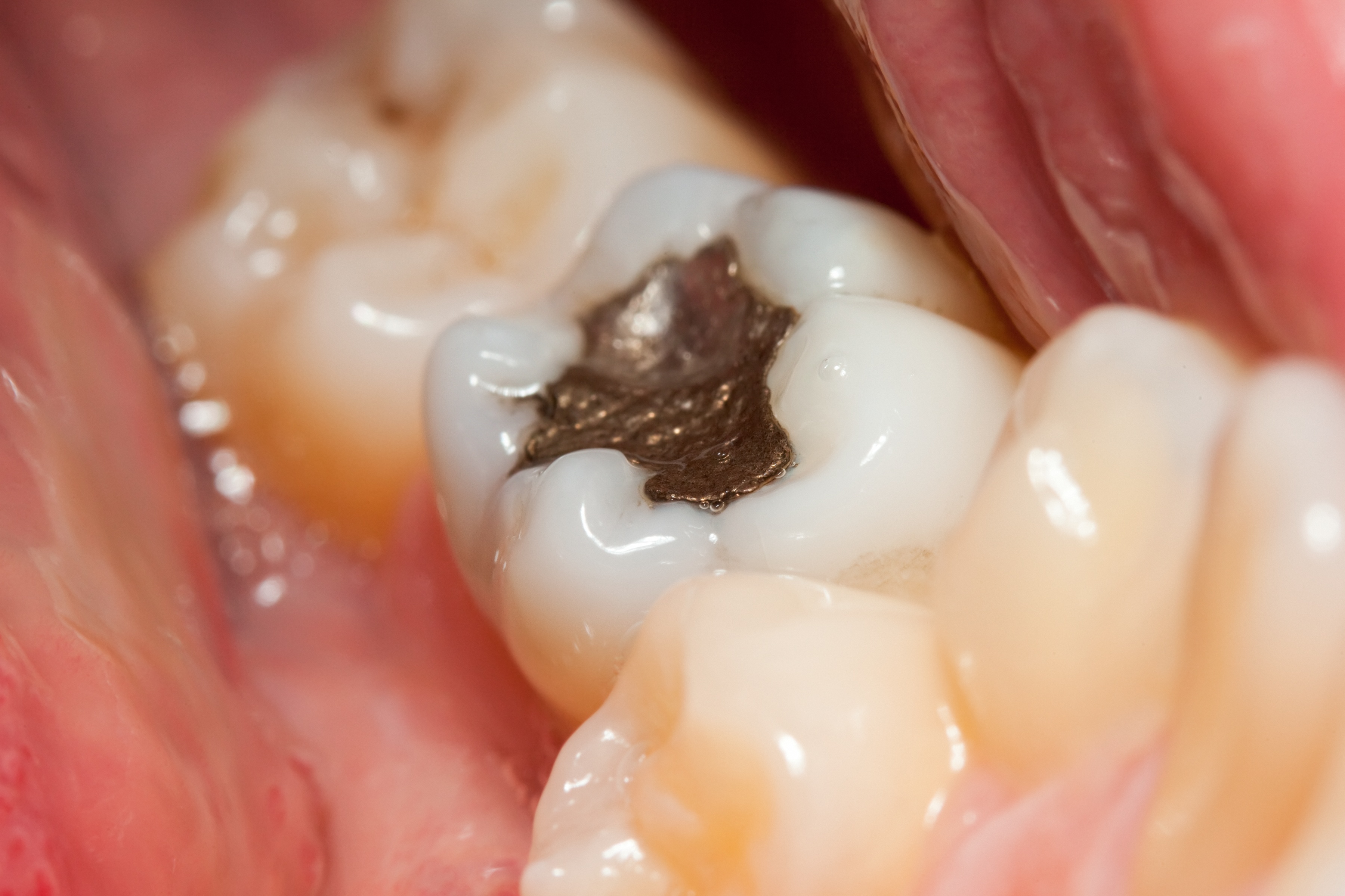 Close-up photo of a tooth with an amalgam filling.
