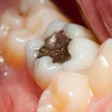Close-up photo of a tooth with an amalgam filling.
