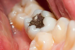 Close-up photo of a tooth with an amalgam filling.