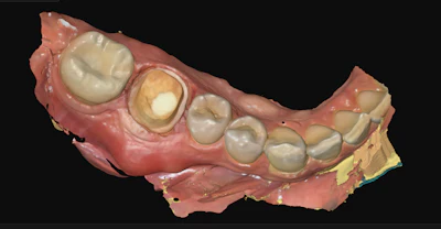 3D dental prosthetic model showing artificial teeth on pink resin base with yellow mounting block