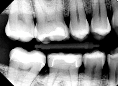 Dental X-ray showing upper and lower teeth with bone structure in grayscale radiograph format