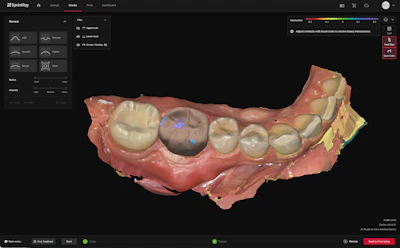 3D dental imaging software showing mandibular jaw model with teeth visualization and bone structure analysis