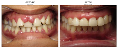 Before and after dental treatment comparison showing improved tooth alignment and gum health over eight months.